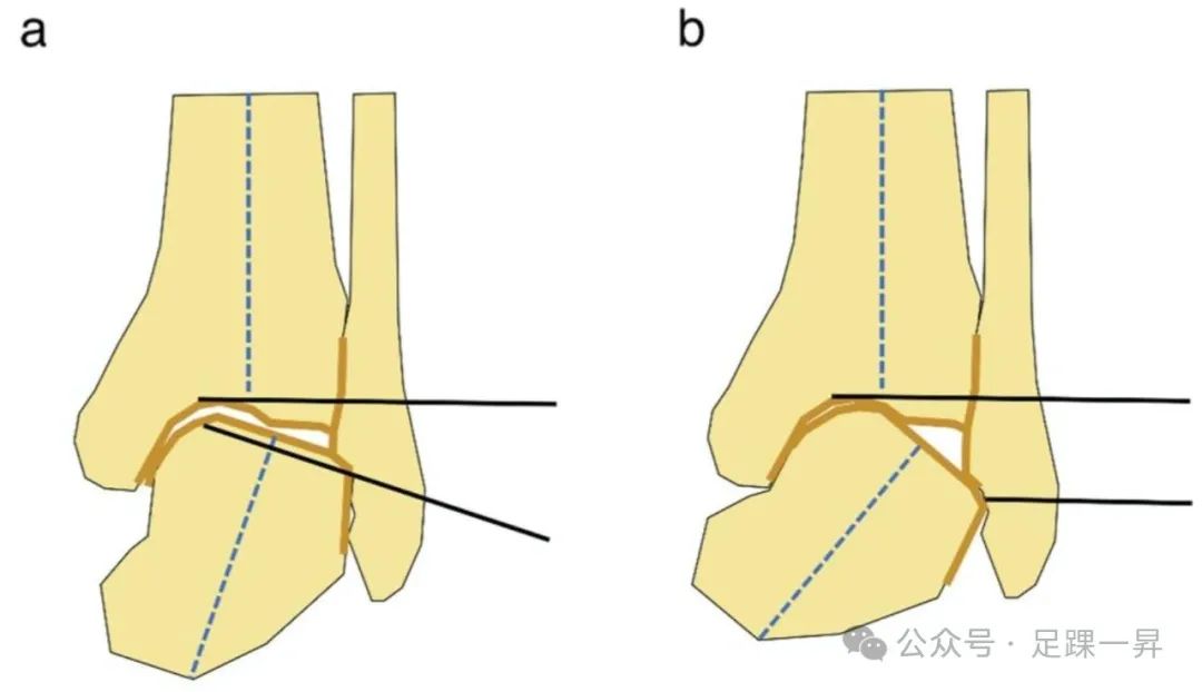 手术技巧｜微创经腓骨入路踝关节融合术