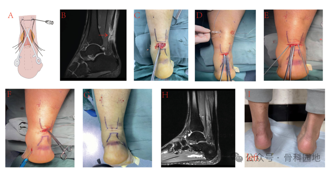 手术技巧｜介绍3种急性跟腱断裂的微创缝合方法