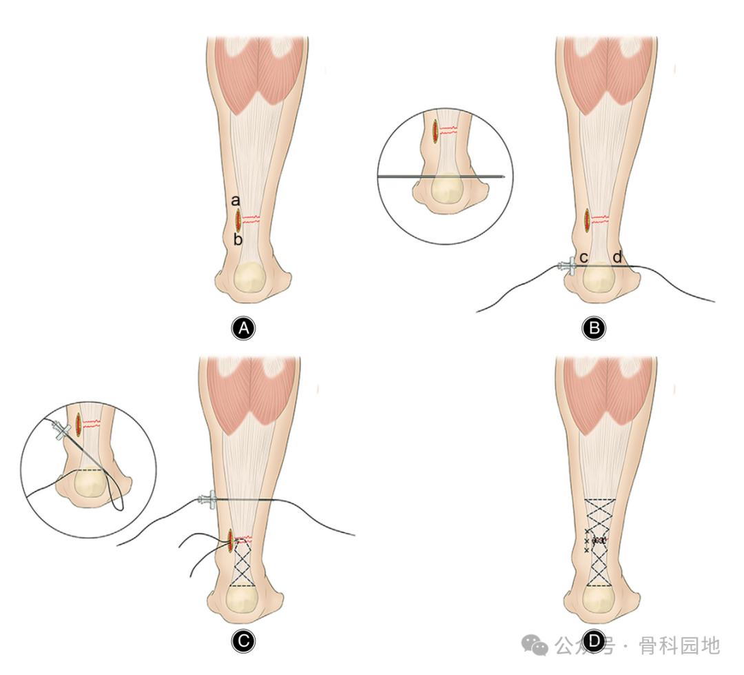 手术技巧｜介绍3种急性跟腱断裂的微创缝合方法