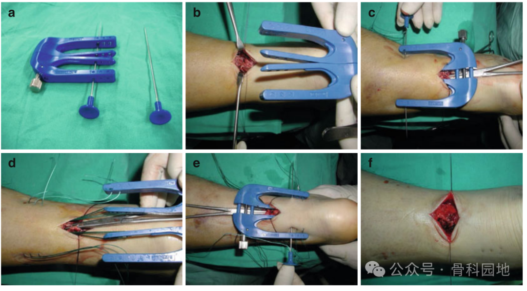 手术技巧｜介绍3种急性跟腱断裂的微创缝合方法