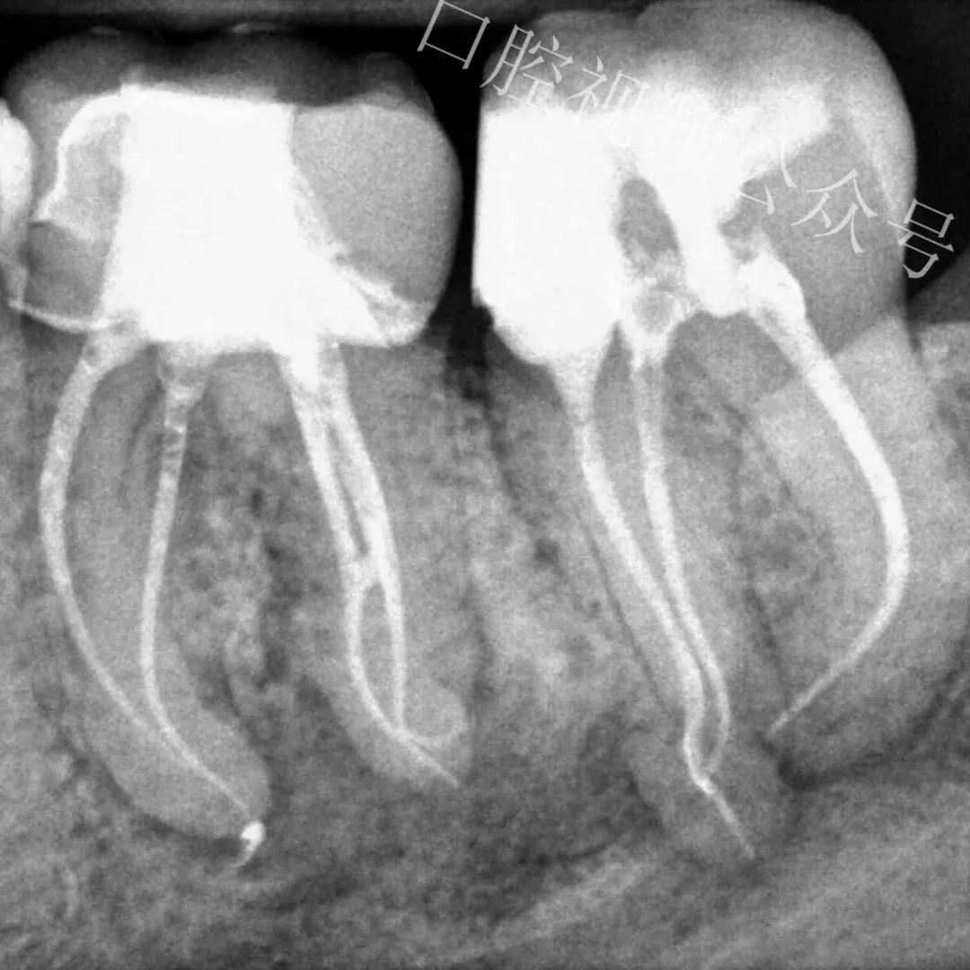 看个高难度根管治疗案例