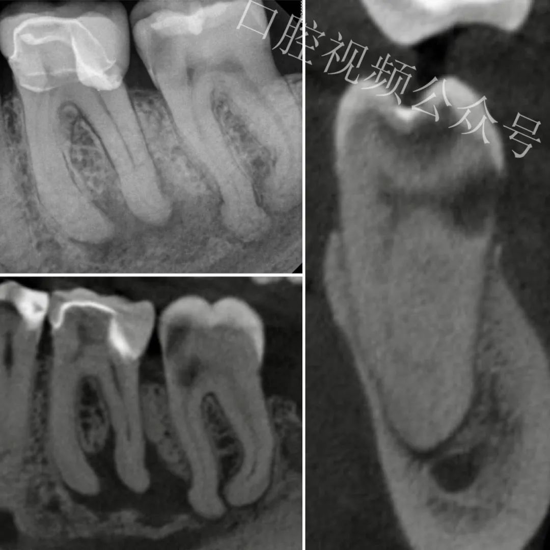 看个高难度根管治疗案例