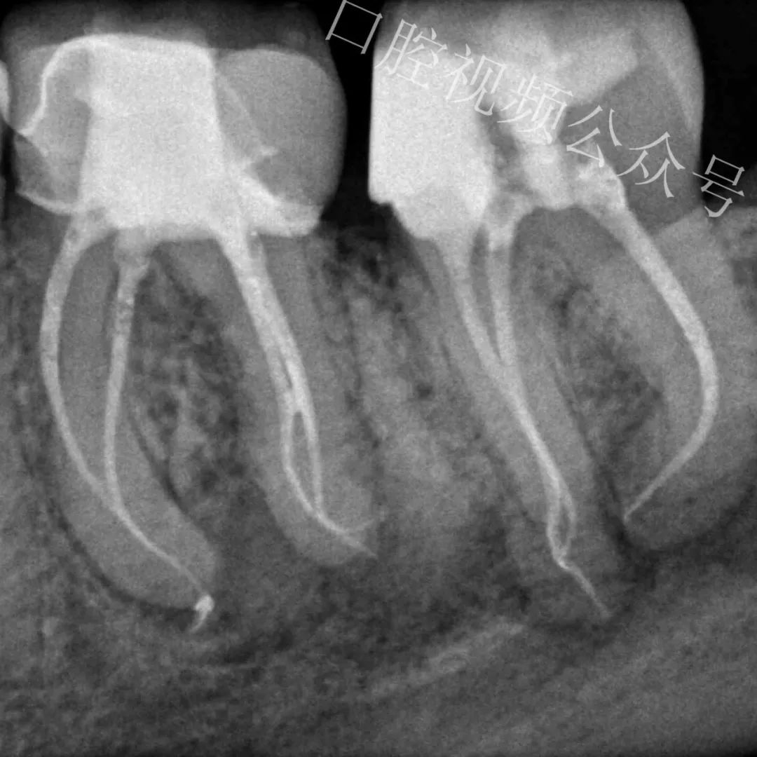 看个高难度根管治疗案例