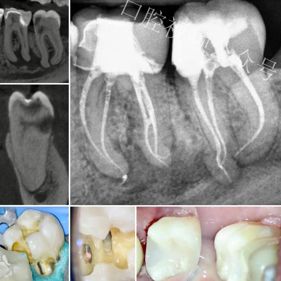 看个高难度根管治疗案例