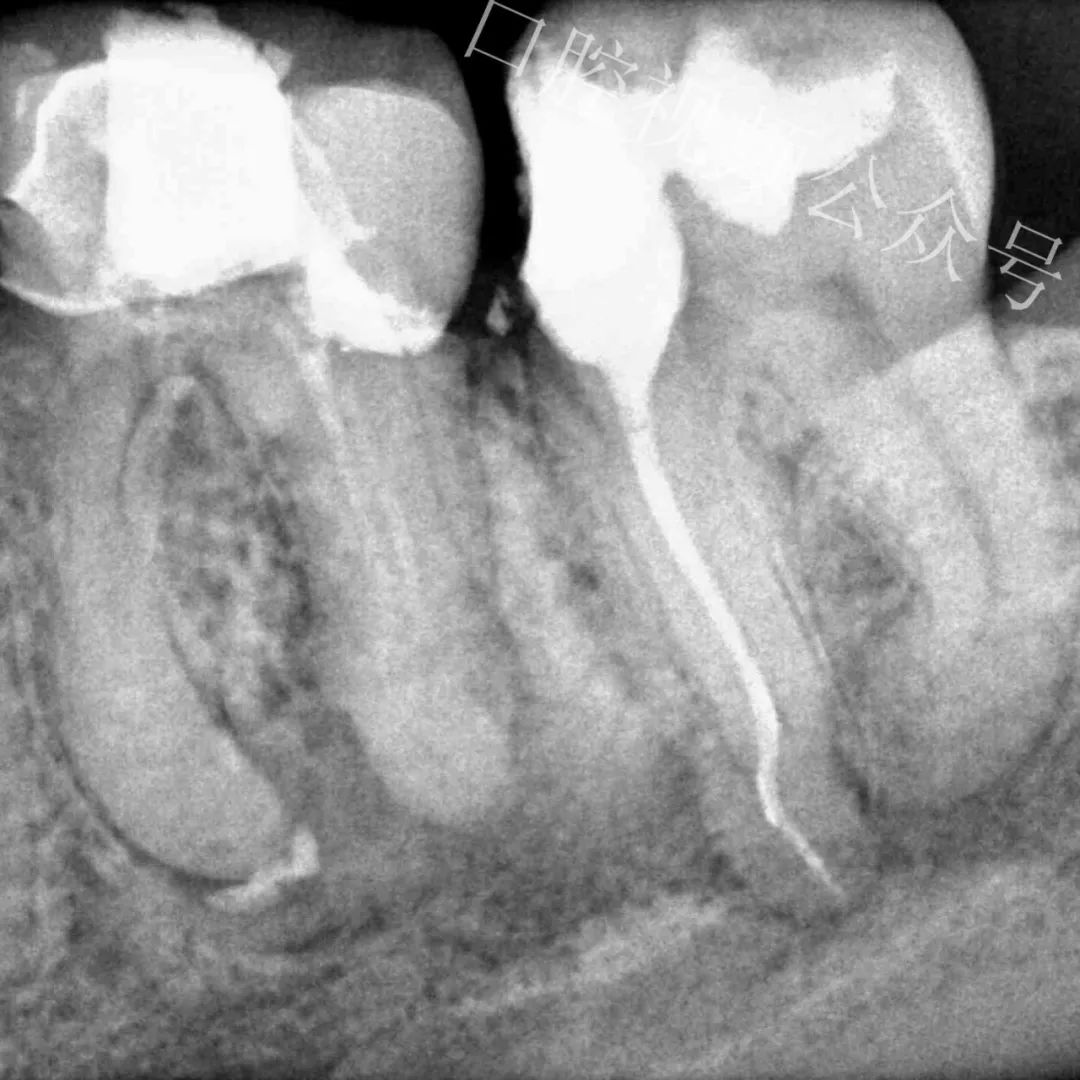 看个高难度根管治疗案例