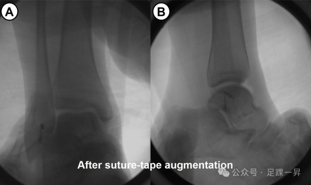 缝线带（Suture-Tape）增强技术在慢性外侧踝关节不稳定解剖修复中的应用