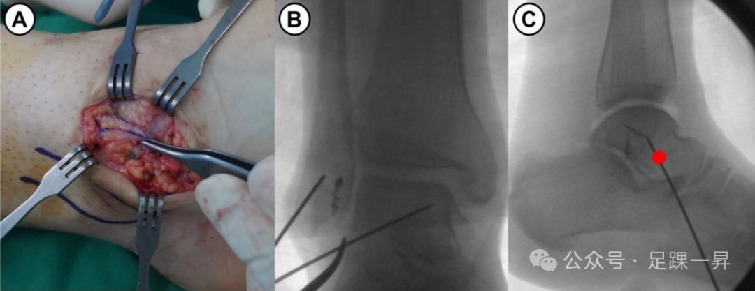 缝线带（Suture-Tape）增强技术在慢性外侧踝关节不稳定解剖修复中的应用