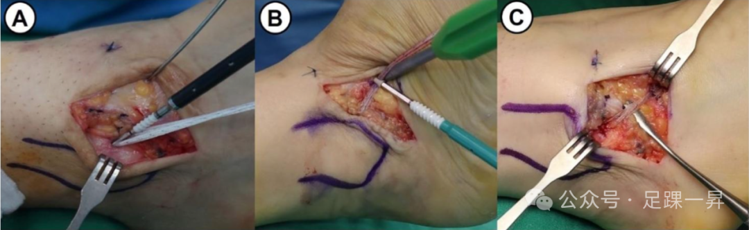 缝线带（Suture-Tape）增强技术在慢性外侧踝关节不稳定解剖修复中的应用