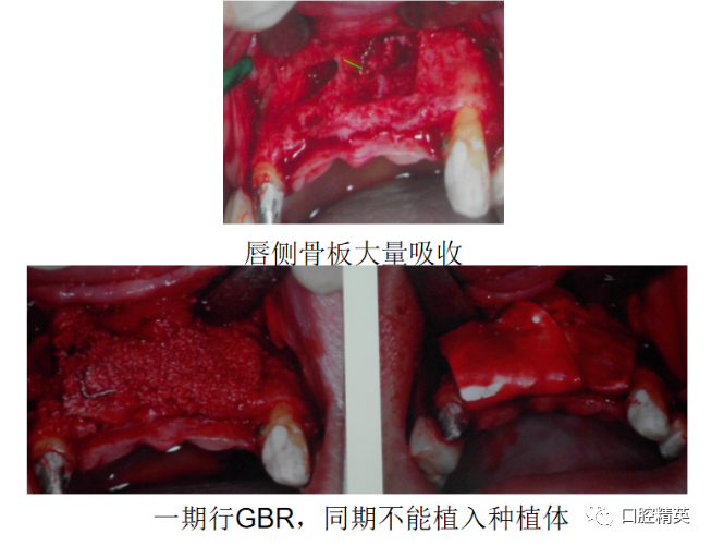 拔牙位点保存,