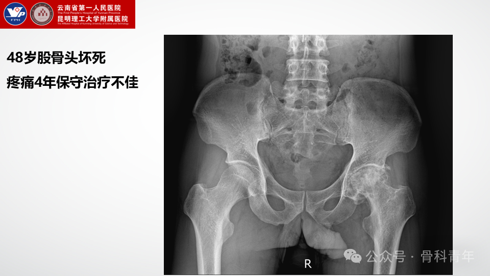 手术步骤