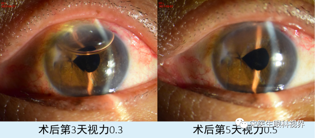 病例分享：一例眼球贯通伤的治疗