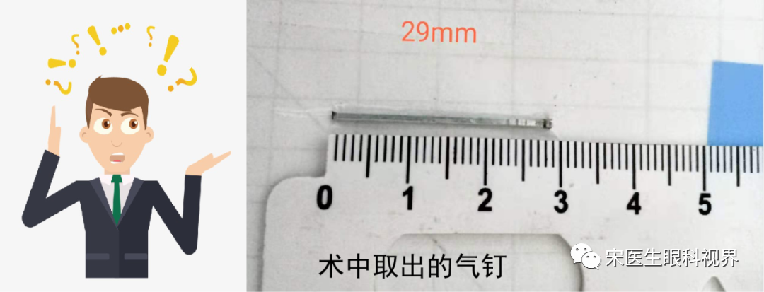 病例分享：一例眼球贯通伤的治疗