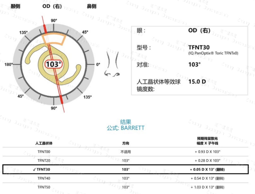 病历分享｜屈光白内障手术-低度近视患者——PanOptix