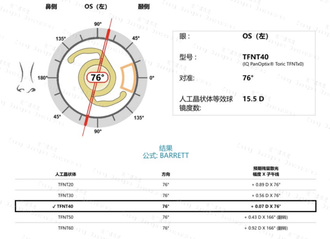 病历分享｜屈光白内障手术-低度近视患者——PanOptix