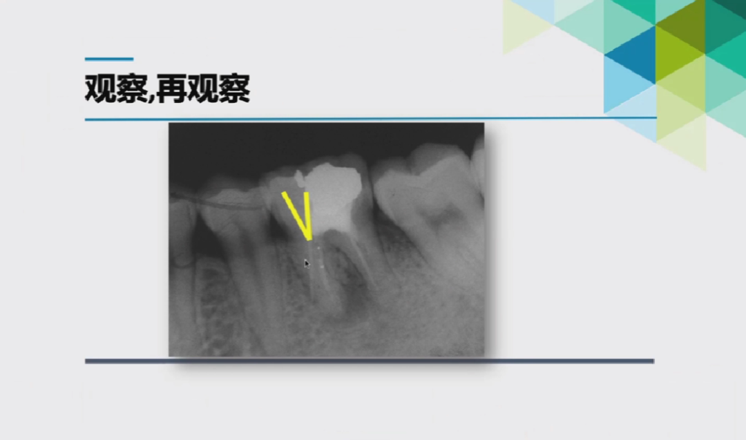 慎始如终：做好根管治疗的第一步