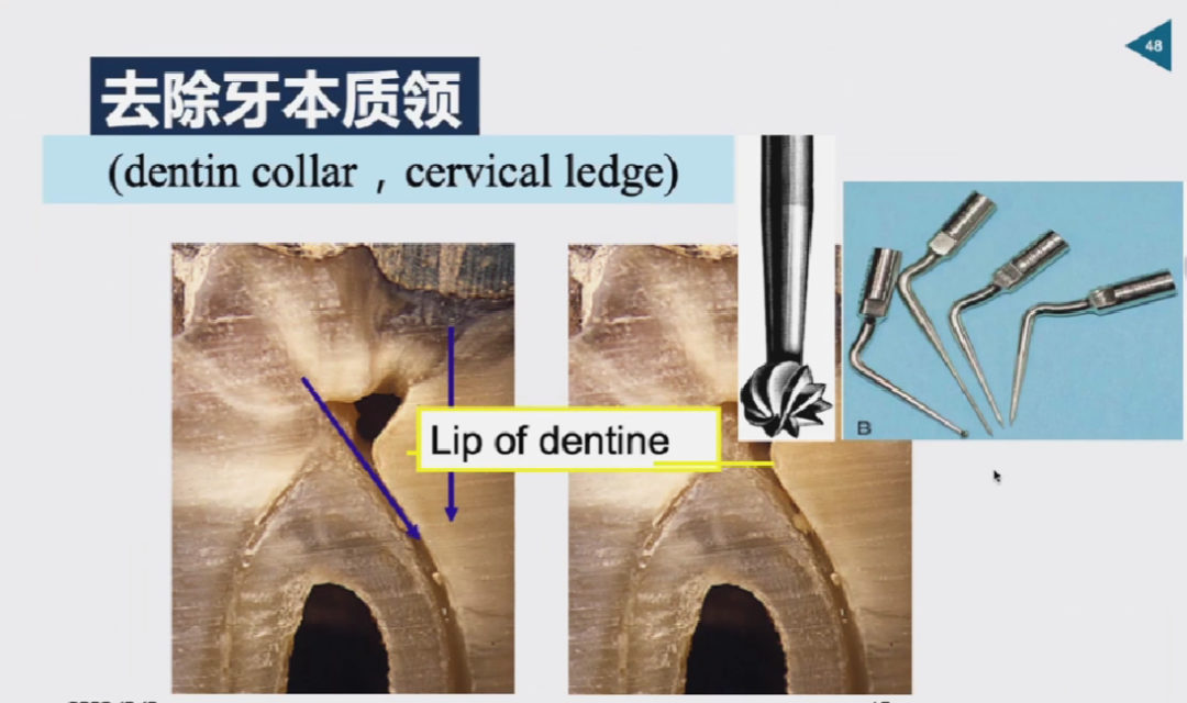 慎始如终：做好根管治疗的第一步