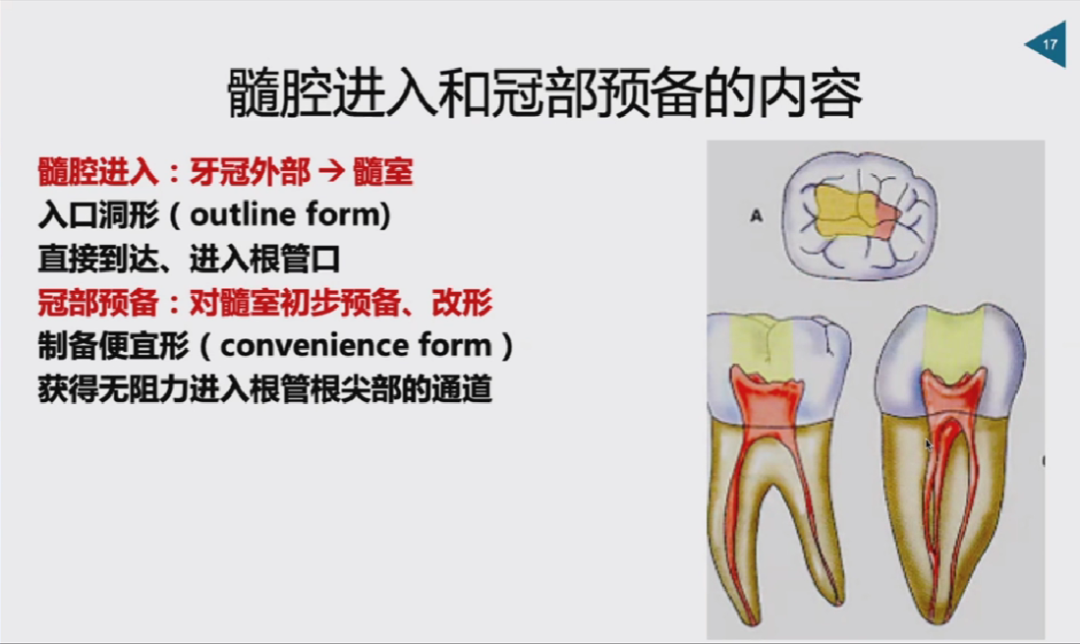 慎始如终：做好根管治疗的第一步