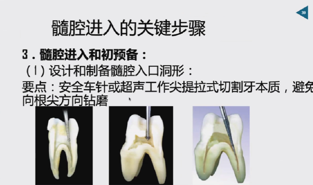 慎始如终：做好根管治疗的第一步