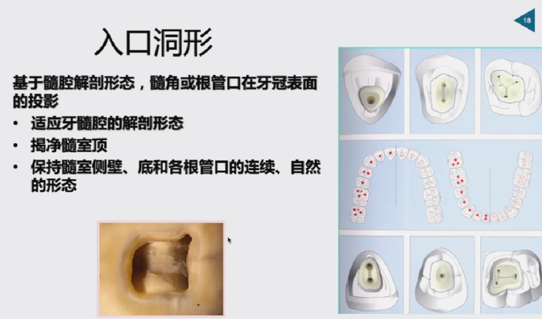 慎始如终：做好根管治疗的第一步