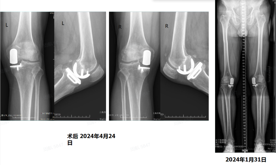 涂意辉教授精讲：单髁置换术现代适应证-年轻患者