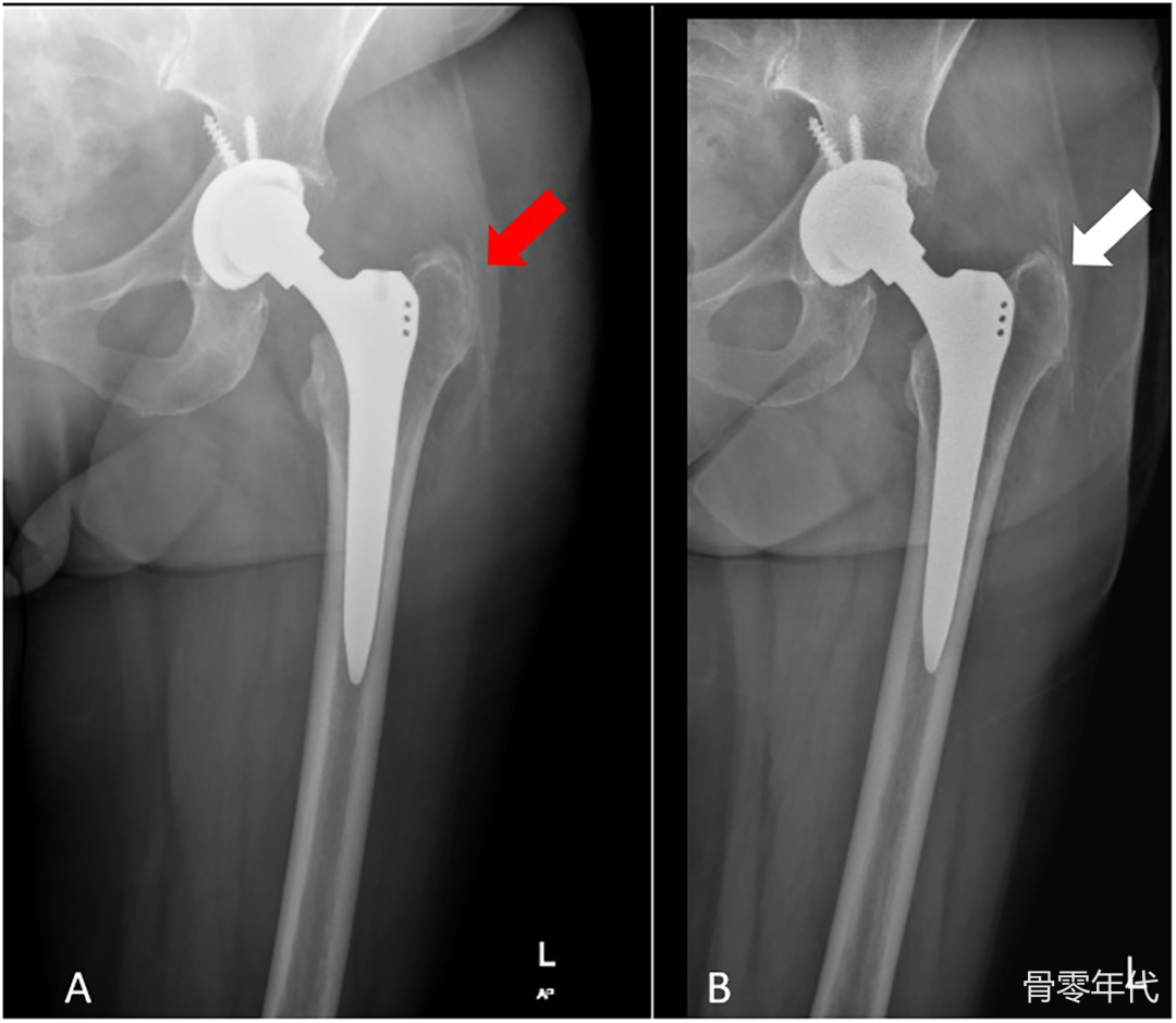 因残留引流管导致的Trendelenburg步态：全髋关节置换术