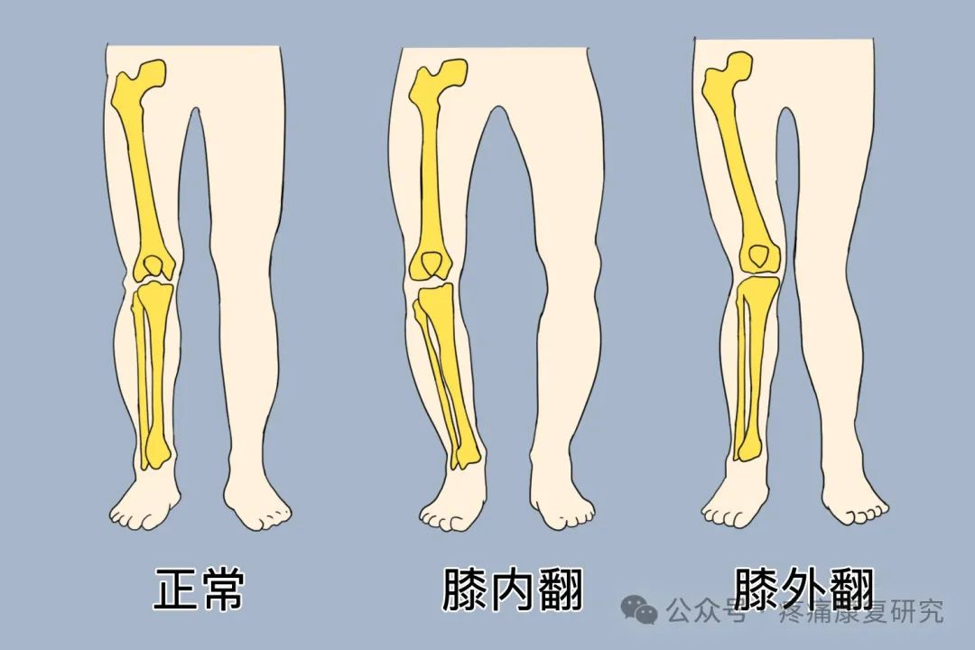 臀中肌：腰-腿-膝联动疼痛的关键治疗点