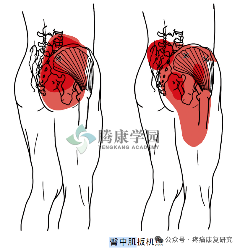 臀中肌：腰-腿-膝联动疼痛的关键治疗点