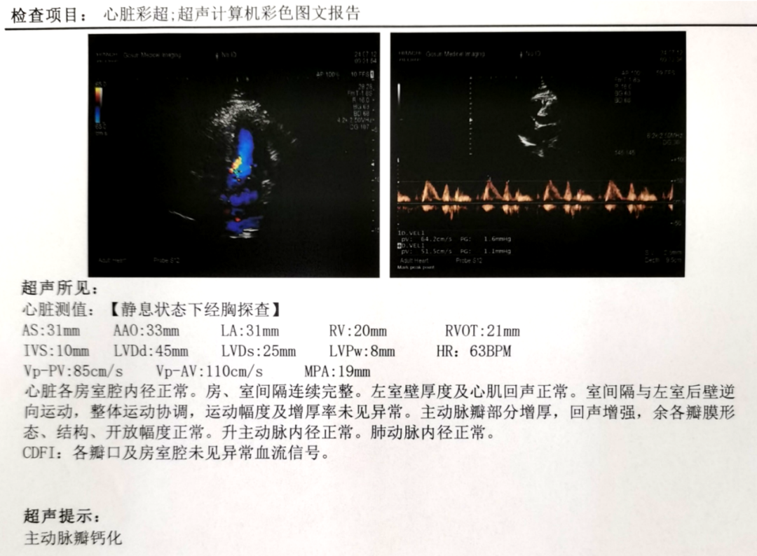 病历分享｜白内障术后罕见并发症-CRAO