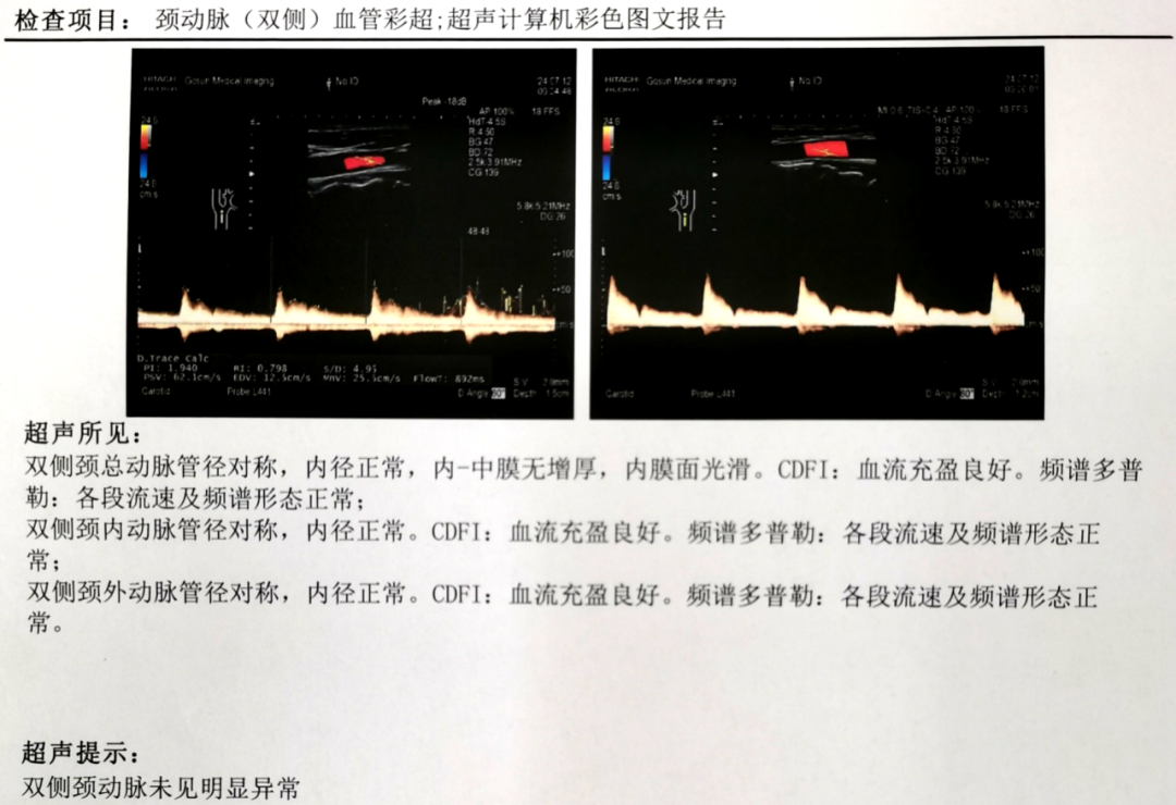 病历分享｜白内障术后罕见并发症-CRAO