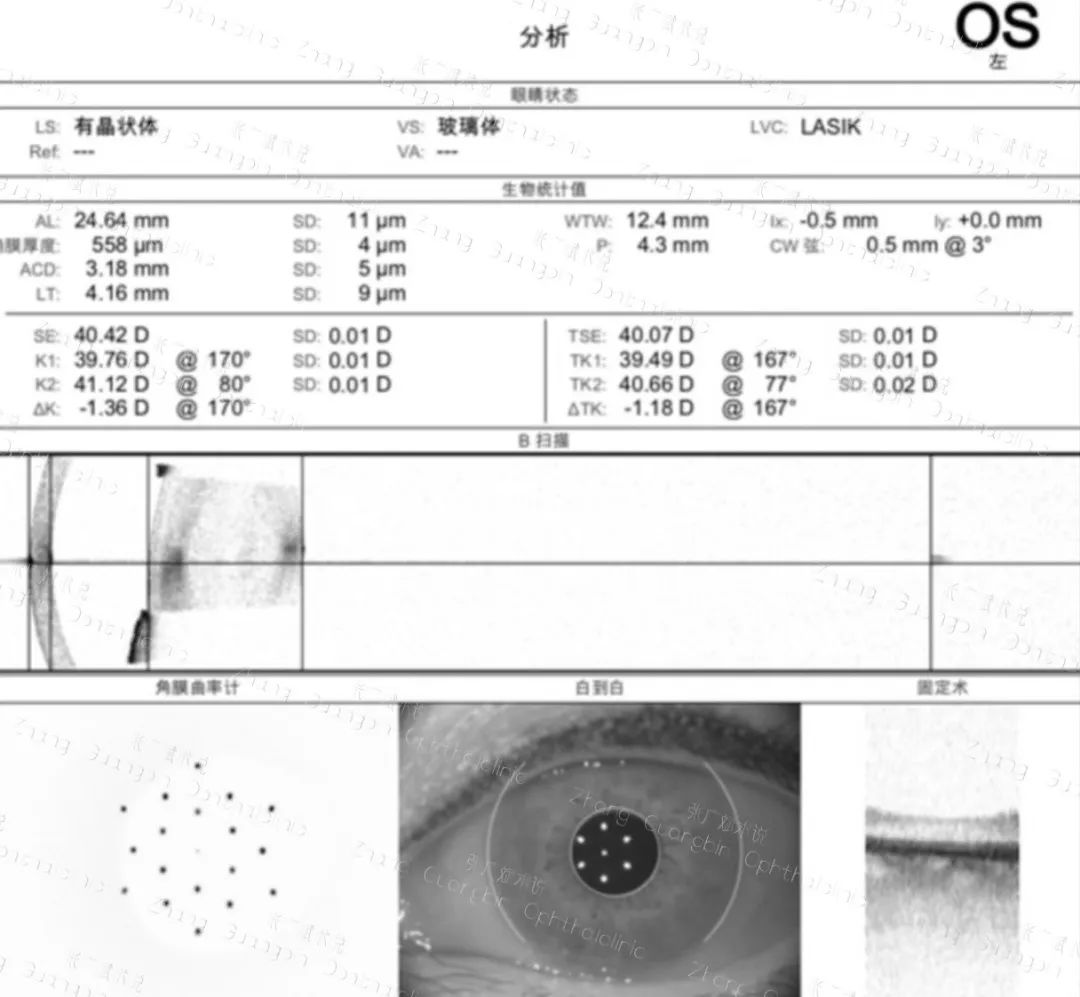 病历分享｜角膜屈光术后白内障手术