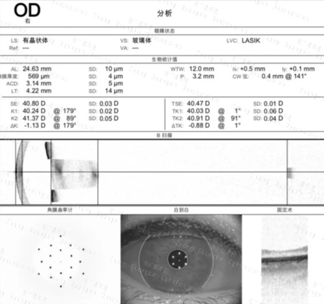 病历分享｜角膜屈光术后白内障手术