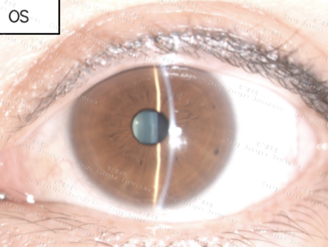 病历分享｜角膜屈光术后白内障手术