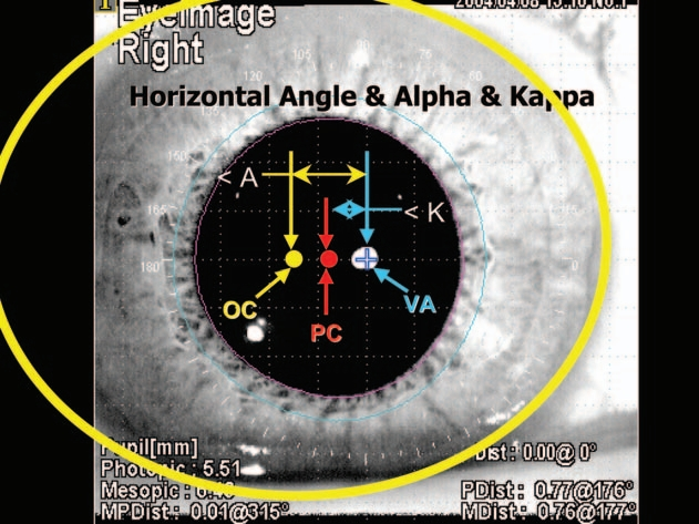 白内障可以引起Alpha角与Kappa角改变