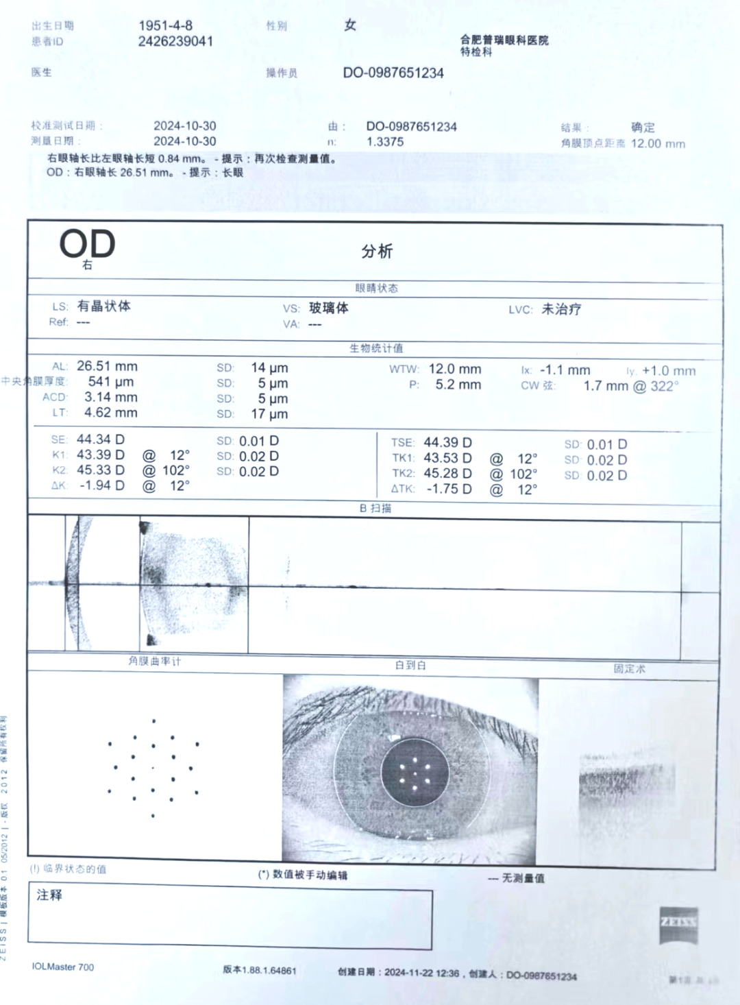 白内障可以引起Alpha角与Kappa角改变