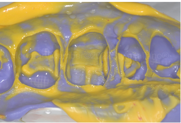 龈壁提升,简化并提升了牙医临床操作水平。