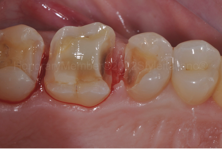 龈壁提升,简化并提升了牙医临床操作水平。