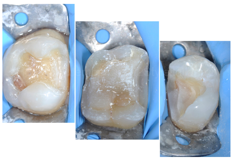 龈壁提升,简化并提升了牙医临床操作水平。
