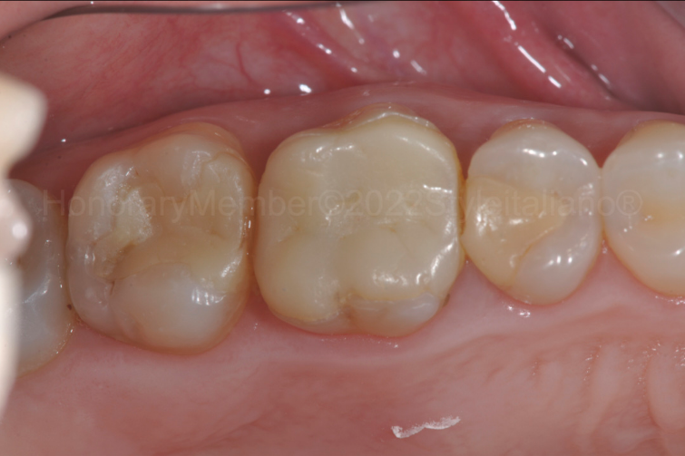 龈壁提升,简化并提升了牙医临床操作水平。