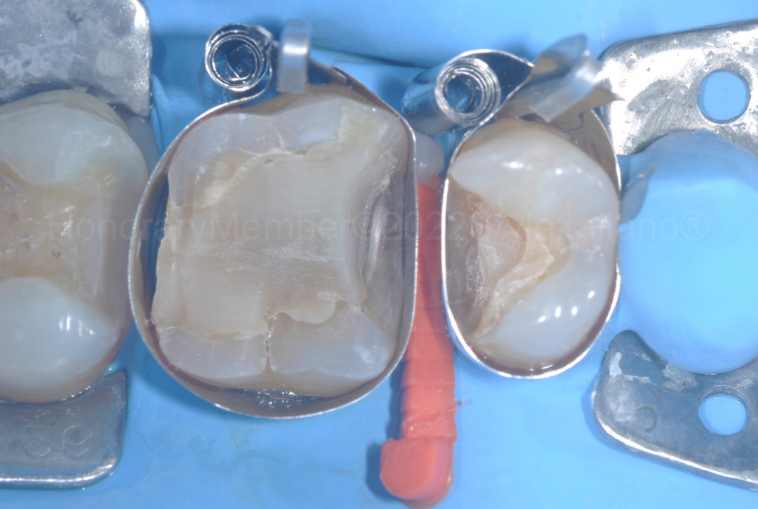 龈壁提升,简化并提升了牙医临床操作水平。