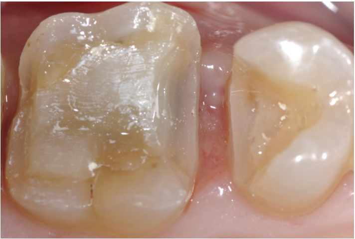 龈壁提升,简化并提升了牙医临床操作水平。