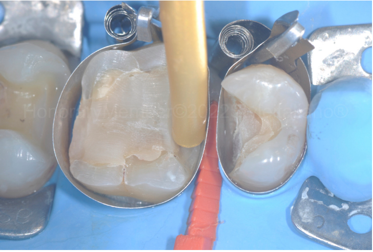 龈壁提升,简化并提升了牙医临床操作水平。