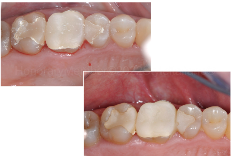 龈壁提升,简化并提升了牙医临床操作水平。