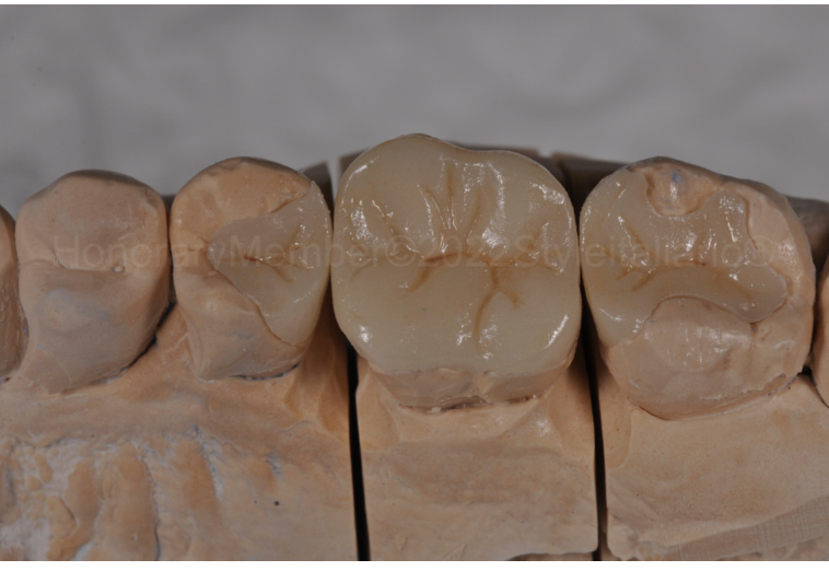 龈壁提升,简化并提升了牙医临床操作水平。