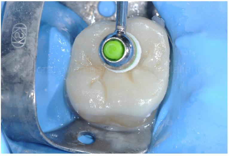 龈壁提升,简化并提升了牙医临床操作水平。