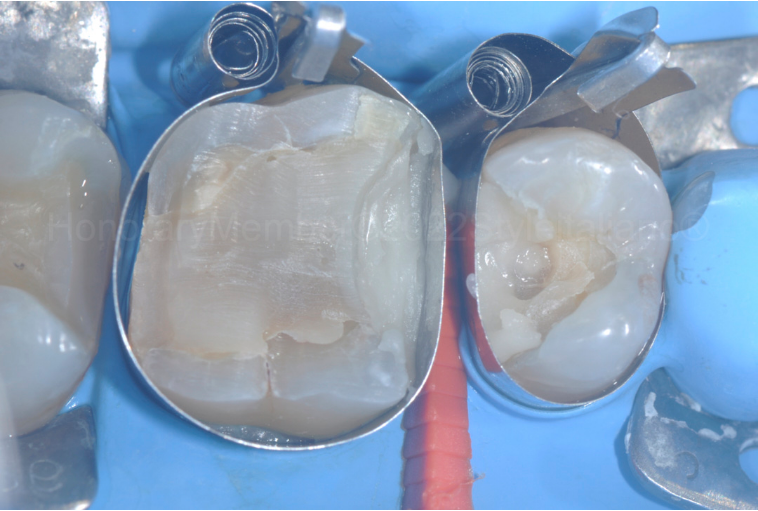 龈壁提升,简化并提升了牙医临床操作水平。