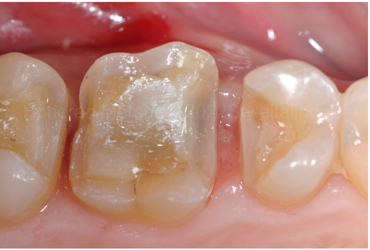 龈壁提升,简化并提升了牙医临床操作水平。