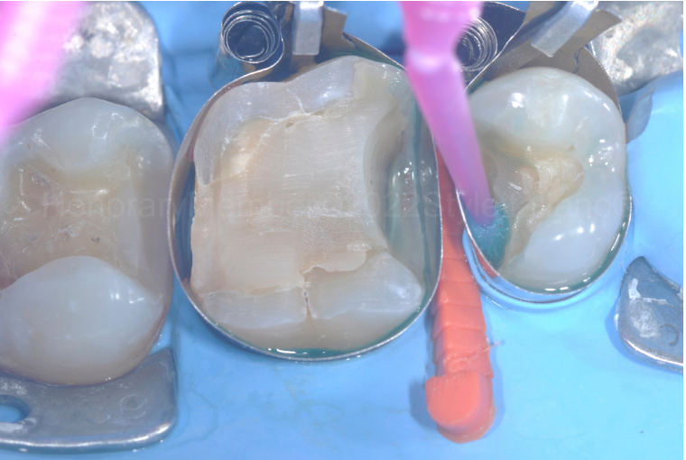 龈壁提升,简化并提升了牙医临床操作水平。