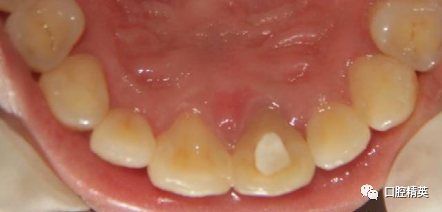 前牙根尖囊肿根尖切除手术