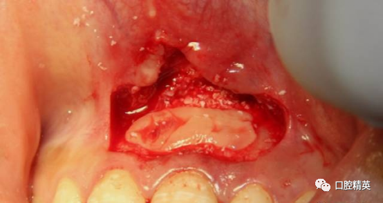 前牙根尖囊肿根尖切除手术