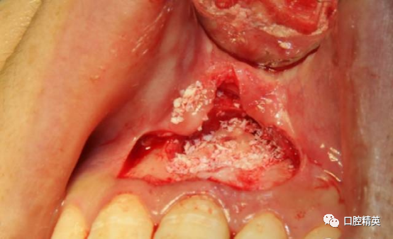 前牙根尖囊肿根尖切除手术